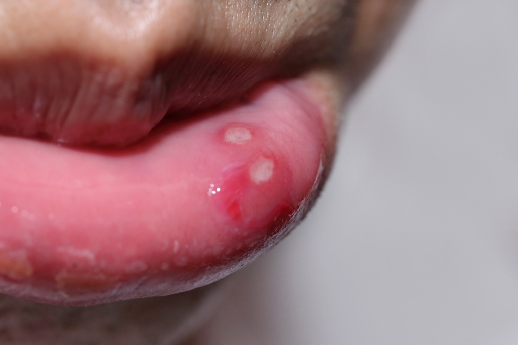 Canker sore Silent health Symptoms