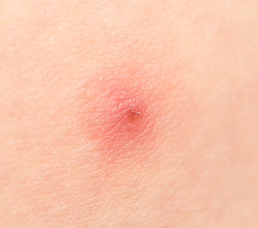 Redness From a Bee Sting