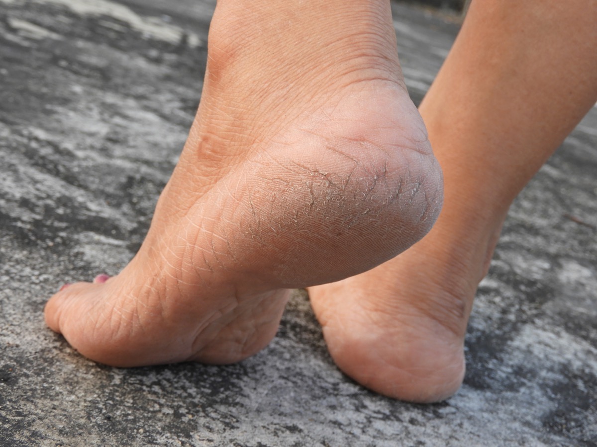 cracked heels