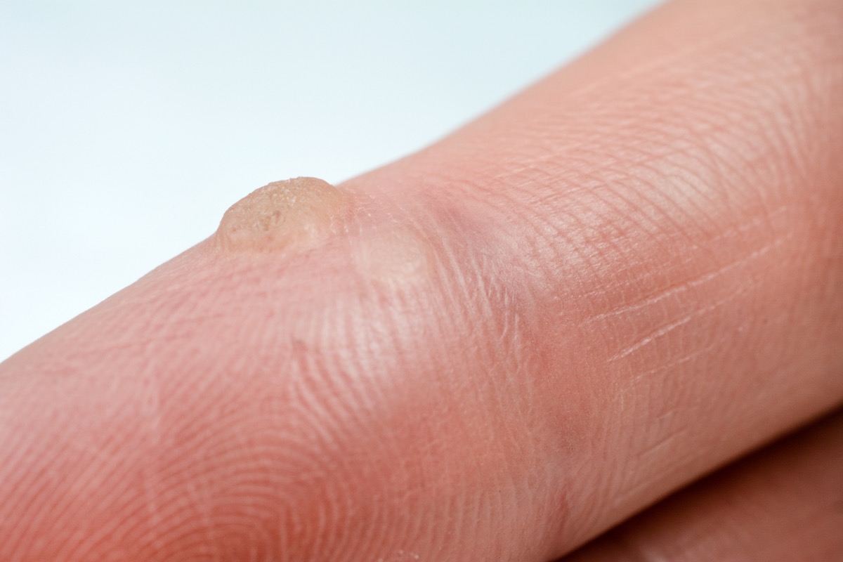 wart on the finger verruca freeze concept blurred neutral background, selective focus