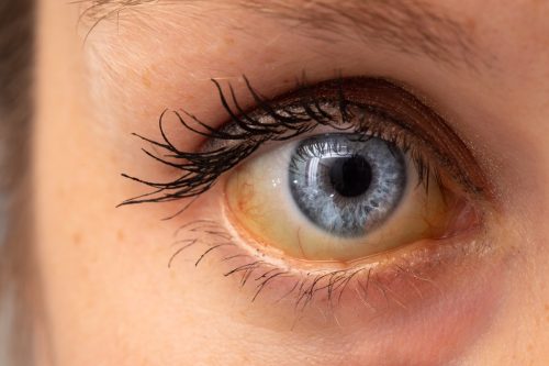 yellow jaundice in the eye
