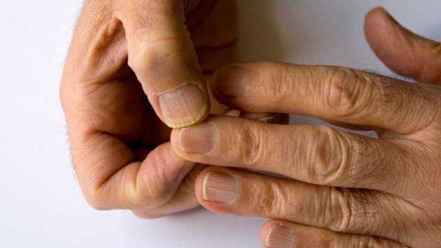 brittle nails on hands