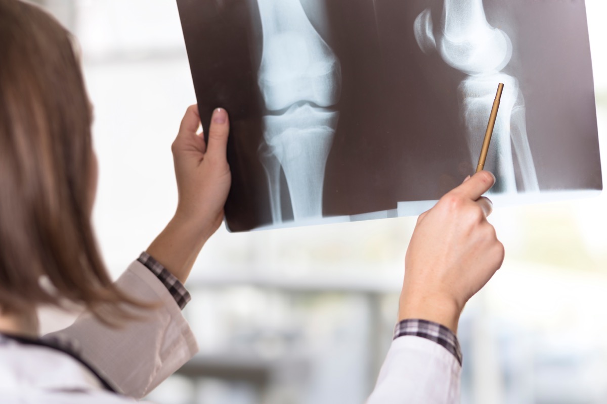 doctor looking at X-Ray of Bones