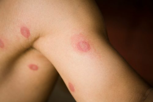 "male with multiple ringworm infections. Any of a number of contagious skin diseases caused by several related fungi, characterized by ring-shaped, scaly, itching patches on the skin and generally classified by its location on the body. Also called tinea.Ringworm is a fungal infection of the skin in humans and domestic animals such as sheep and cattle. Fungi are organisms that survive by eating plant or animal material. Those that cause parasitic infection (dermatophytes) feed on keratin, the material found in the outer layer of skin, hair, and nails. These fungi thrive best on skin that is warm and moist."