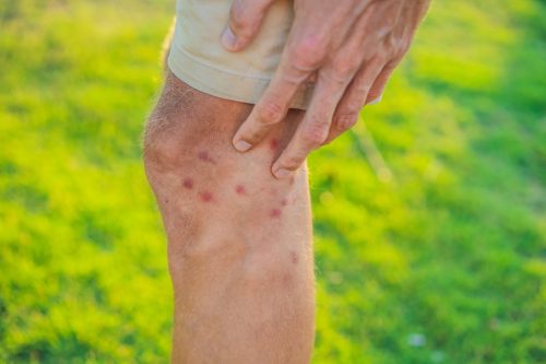 man with sand fly bites