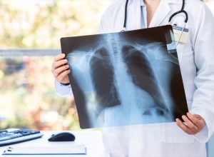 Doctor diagnosing patient’s health on asthma, lung disease, long COVID-19, coronavirus or bone cancer illness with radiological chest x-ray film for medical healthcare hospital service