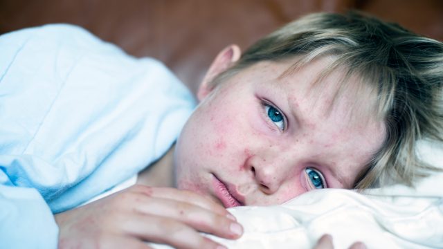 A young boy sick in bed with measles