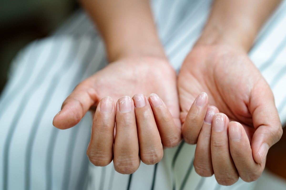 Closeup of woman looking at her fingernails, which are brittle