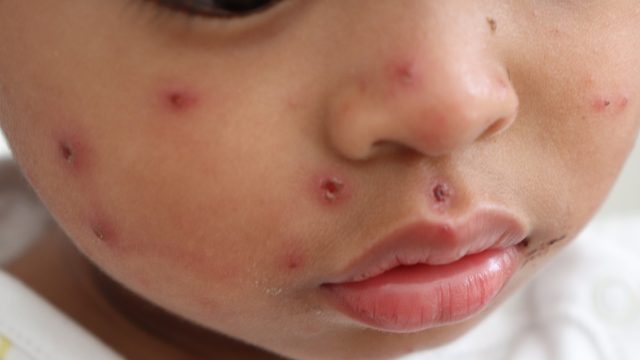 A close up of a baby's face with measles