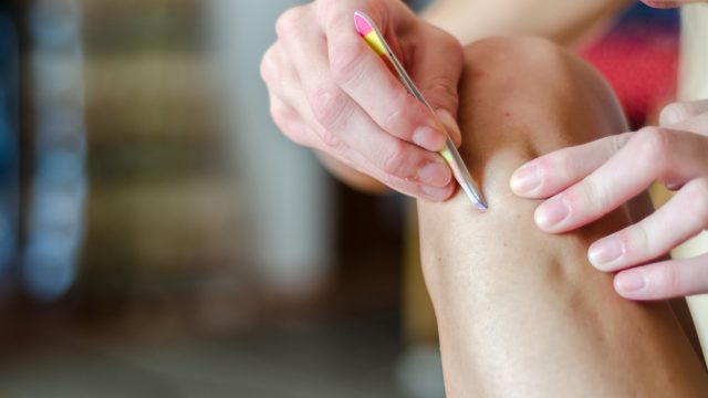 A close up of a person using tweezer to pick an ingrown hair from their leg
