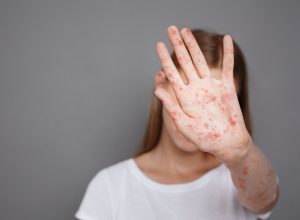 Doctor's Warning as Measles Hits 3 New States