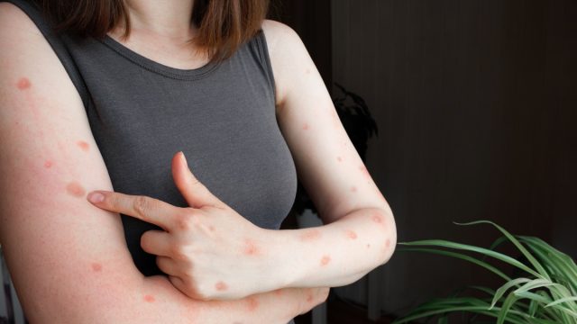 Monkeypox new disease dangerous over the world. Patient with Monkey Pox. Painful rash, red spots blisters. Close up rash, human hands with Health problem. Banner, copy space. mpox. Dengue fever