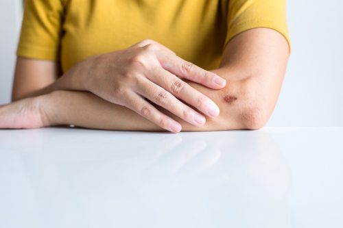 woman tapping fingers on arm