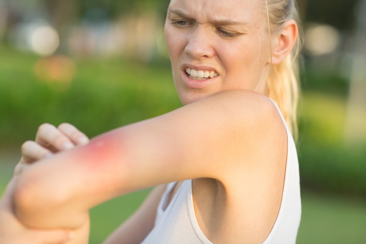 young blonde woman scratching a mosquito bite outside